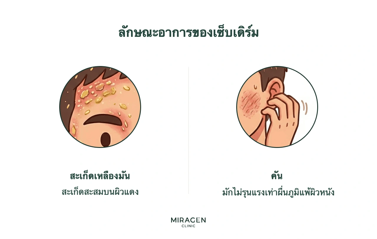 อินโฟกราฟิกสองอาการเด่นของผิวหนังอักเสบเซ็บเดิร์ม คือขุยเหลืองมันบนผิวแดงและอาการคันที่มักเบากว่าผื่นภูมิแพ้ผิวหนัง
