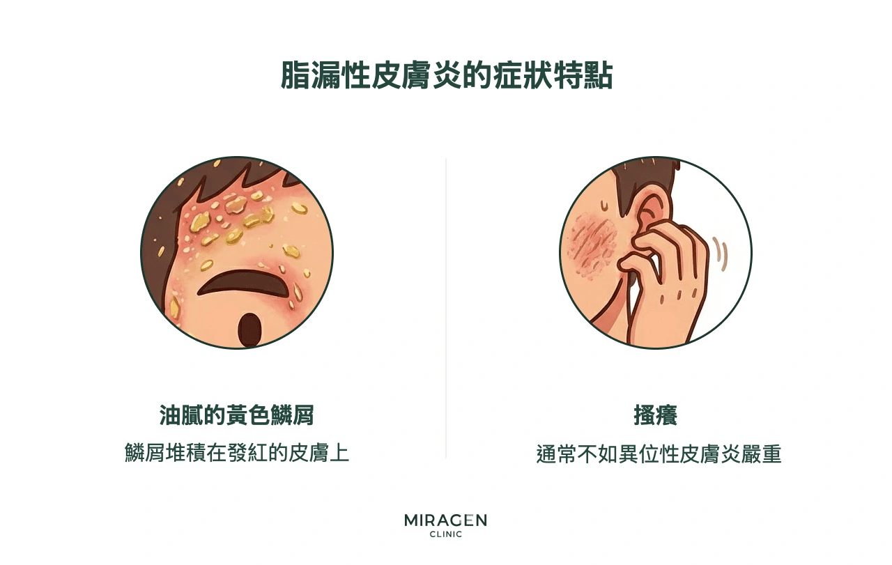 資訊圖:脂漏性皮膚炎的兩種典型表現——發紅皮膚上油膩的黃色皮屑,以及通常位元應性皮膚炎輕的搔癢