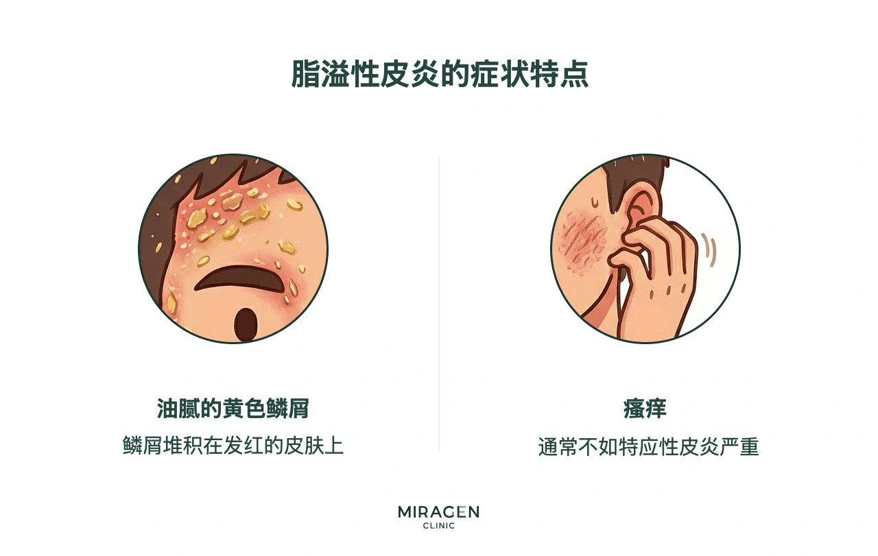 信息图：脂溢性皮炎的两种典型表现——发红皮肤上油腻的黄色皮屑，以及通常比特应性皮炎轻的瘙痒