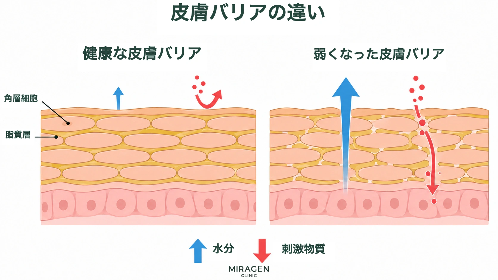 ステロイド軟膏の副作用である皮膚バリア弱化を説明する図。健康な皮膚と弱くなった皮膚の角質細胞・脂質層・水分損失・刺激物質の侵入を比較