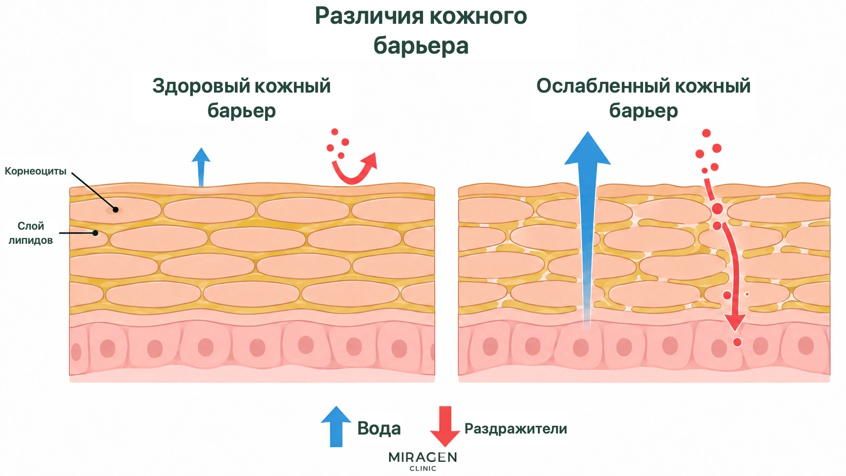 Схема сравнивает здоровый и ослабленный кожный барьер: роговые клетки, липидный слой, потерю воды и проникновение раздражителей