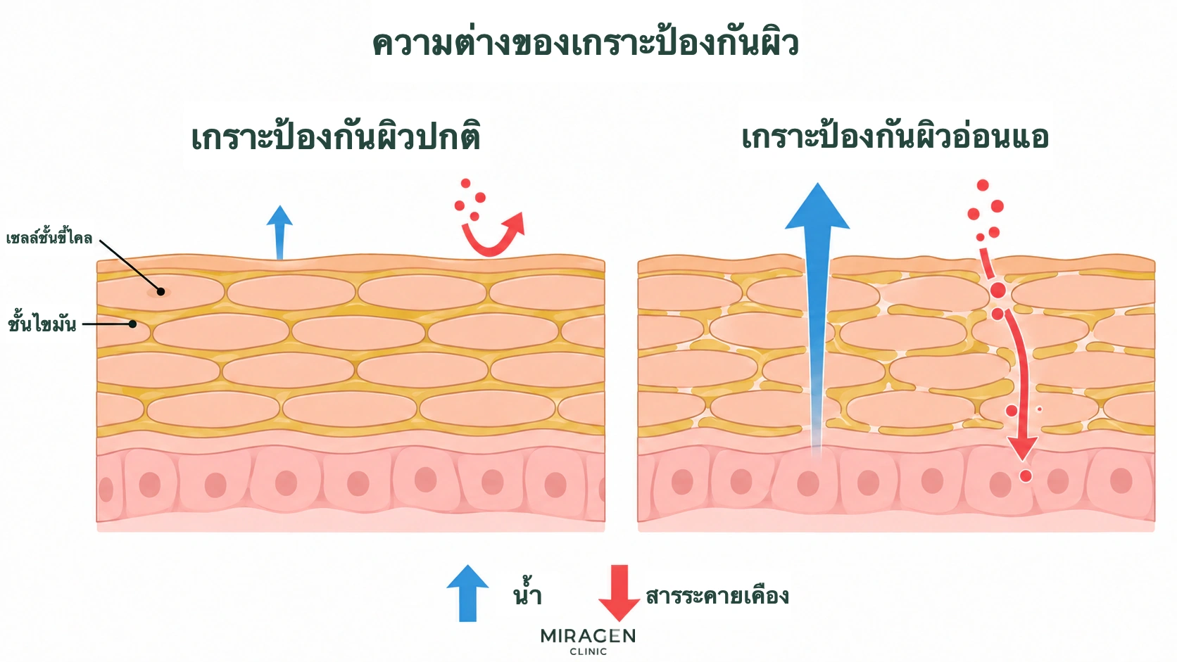 แผนภาพเปรียบเทียบเซลล์ผิวชั้นนอก ชั้นไขมัน การสูญเสียน้ำ และการผ่านของสารระคายเคืองระหว่างผิวปกติกับผิวที่เกราะอ่อนแอจากยาทาสเตียรอยด์