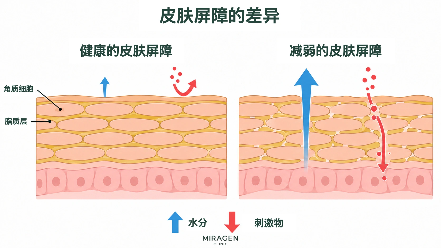 比较健康和薄弱的皮肤屏障中角质细胞、脂质层、水分流失及刺激物进入情况的说明图