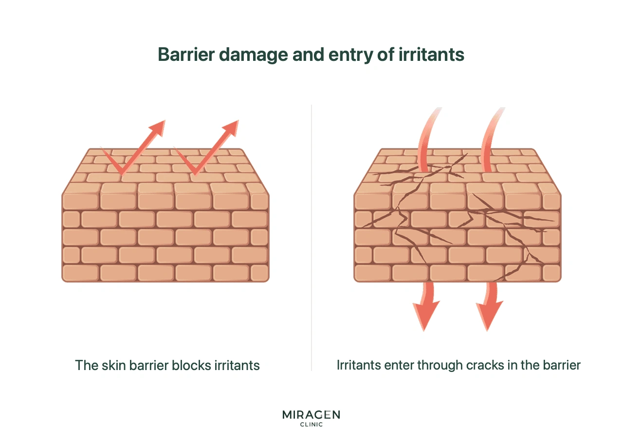 An infographic explaining the root cause of dermatitis using a brick wall analogy — a healthy skin barrier blocks external irritants, whereas a damaged skin barrier allows irritants to penetrate through cracks, triggering atopic dermatitis.