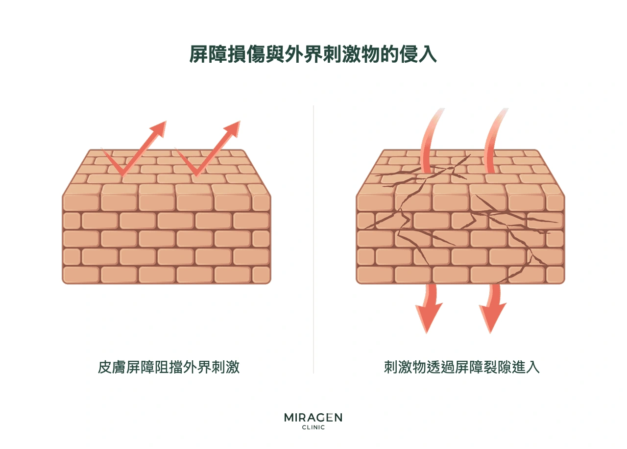 用磚牆比喻說明皮膚炎根本原因的資訊圖：正常皮膚屏障阻擋外界刺激，受損的屏障則有裂縫，使刺激物進入並引起異位性皮膚炎