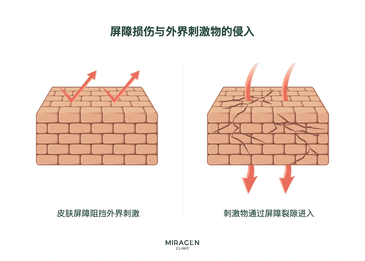 信息图：用砖墙比喻皮肤屏障；完整的屏障阻挡外界刺激，受损屏障则使刺激物从裂缝进入皮肤