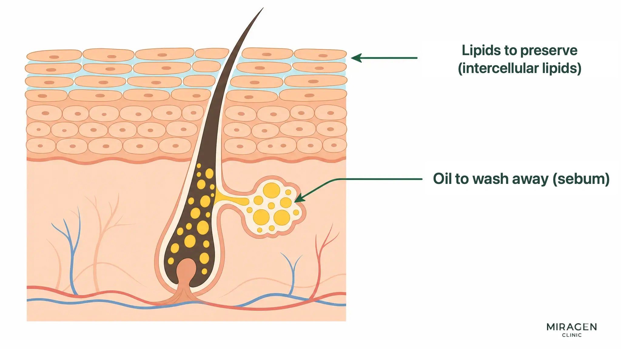 Skin cross-section diagram color-coding sebum in pores (yellow droplets, oil to be washed away) and intercellular lipids filling the spaces between corneocytes (light blue, oil to be protected)