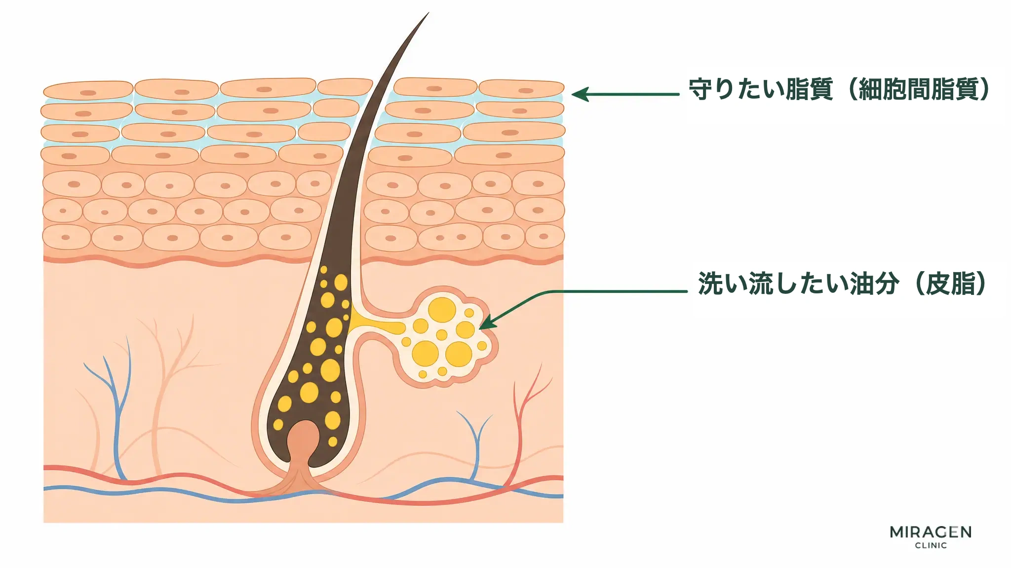 毛穴内の皮脂(黄色のしずく、洗い流すべき油)と、角質細胞の間を埋める細胞間脂質(淡い青色、守るべき油)を色分けした皮膚断面の模式図