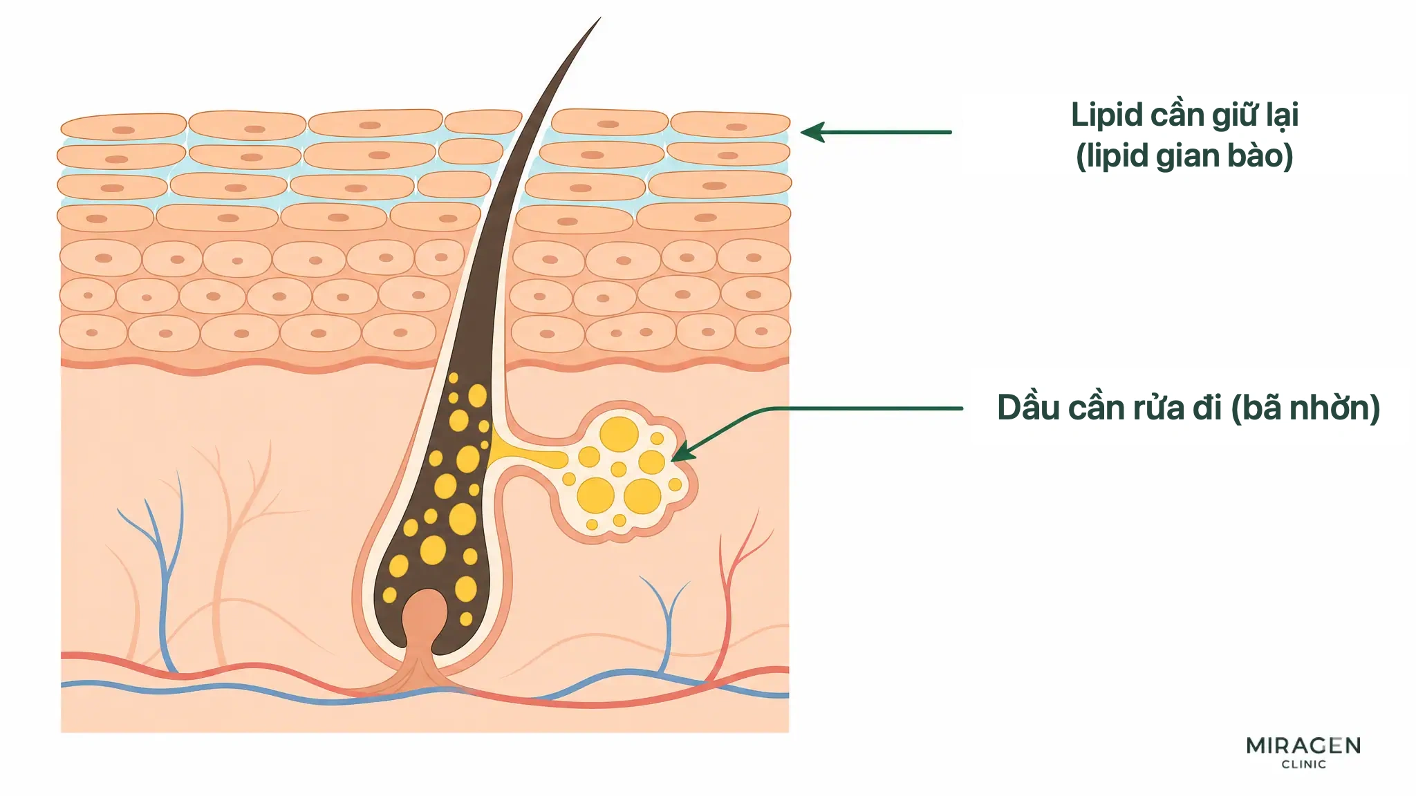 Sơ đồ mặt cắt da phân biệt bã nhờn màu vàng trong lỗ chân lông cần rửa với lipid màu xanh nhạt giữa các tế bào sừng cần giữ lại