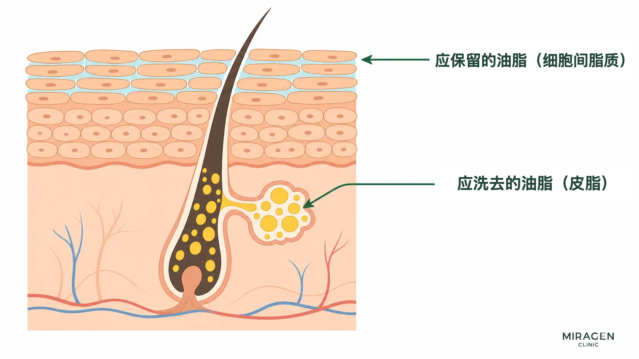 皮肤剖面示意图用颜色区分毛孔中的皮脂（黄色油滴，是需要洗掉的油）和填充角质细胞间的脂质（浅蓝色，是需要保留的油）