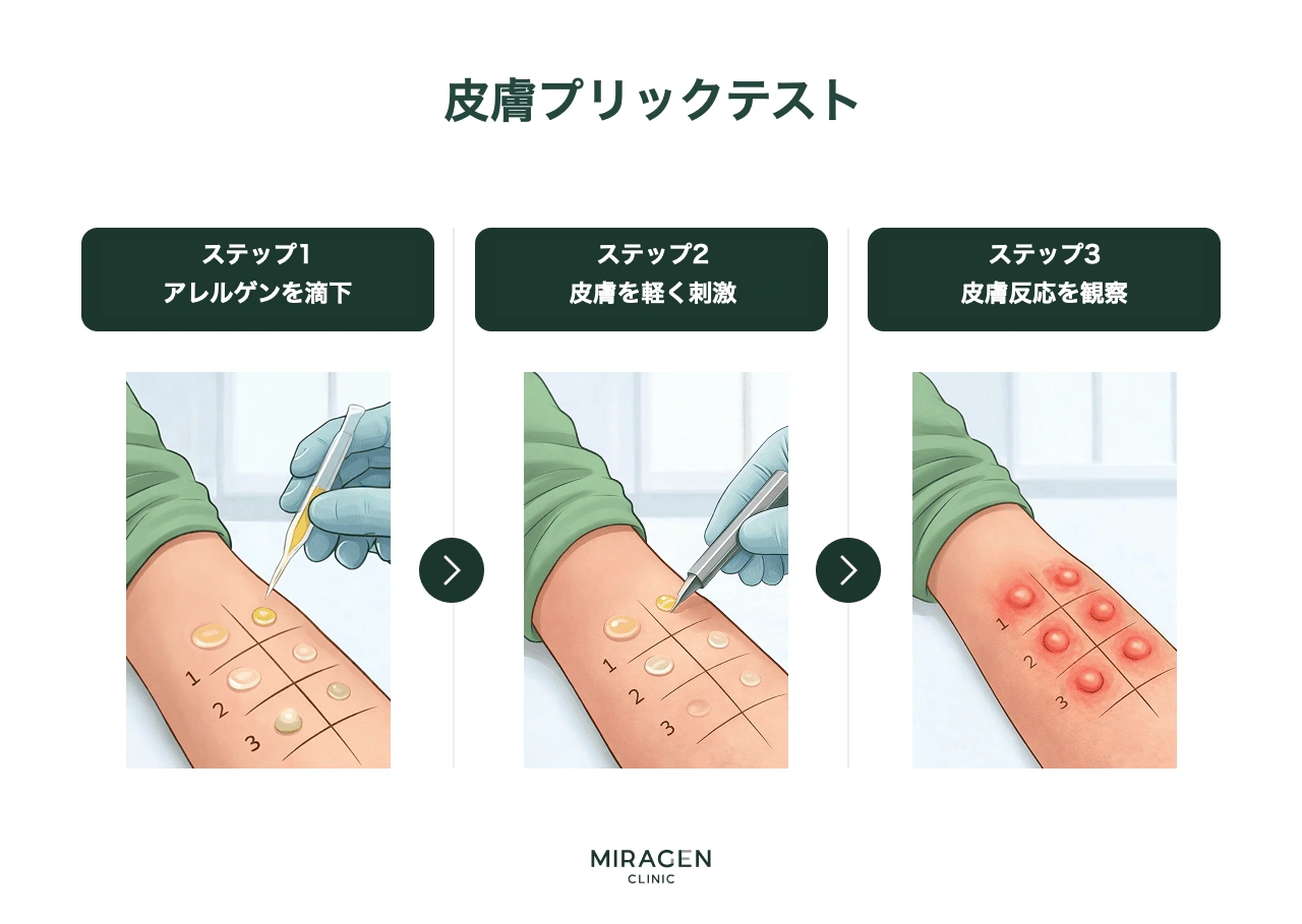以前MAST血液検査の代わりに使用されていた皮膚プリックテストの過程を示すインフォグラフィック