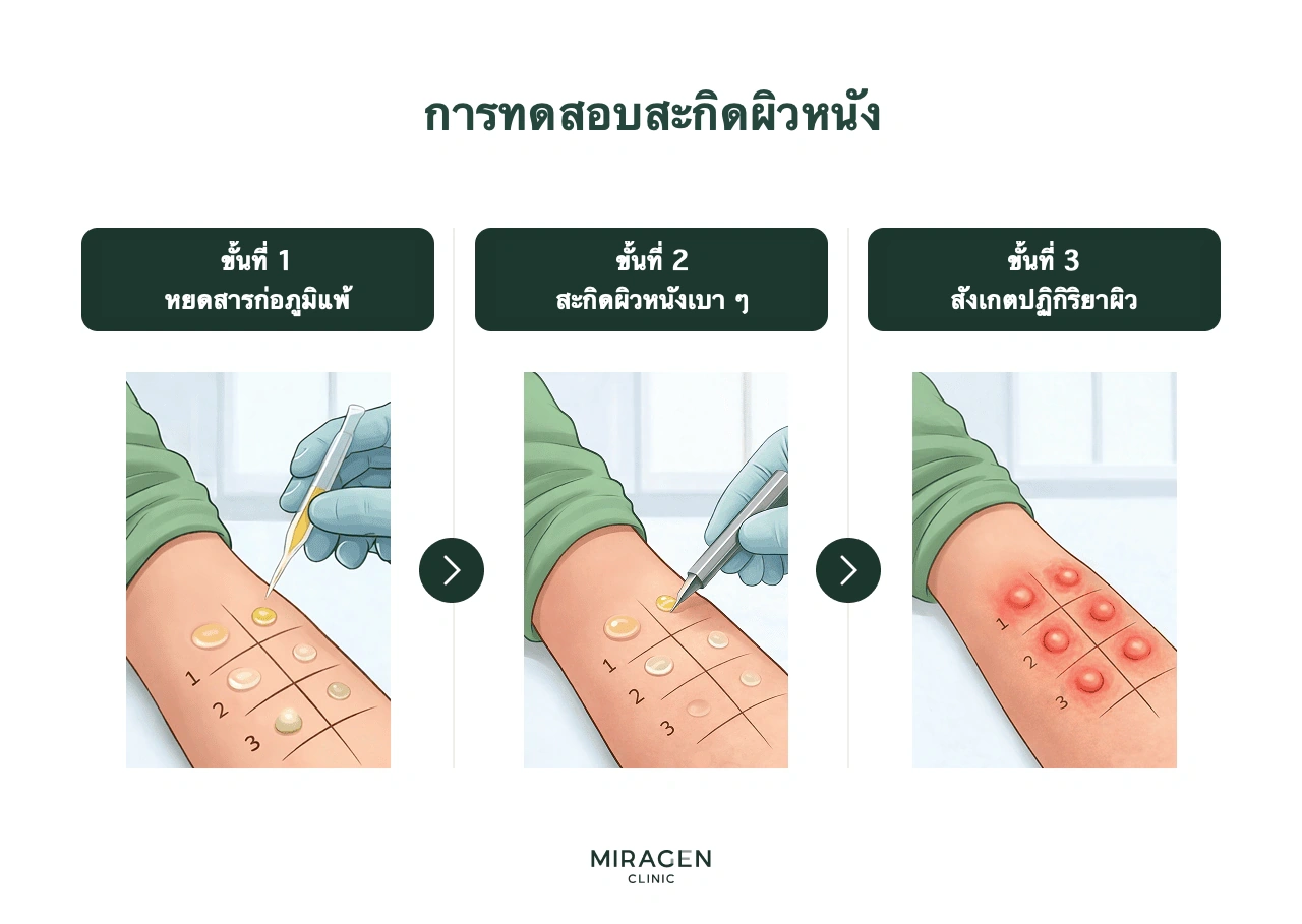 ภาพแสดงขั้นตอนการทดสอบสะกิดผิวหนังซึ่งเคยใช้แทนการตรวจเลือด MAST