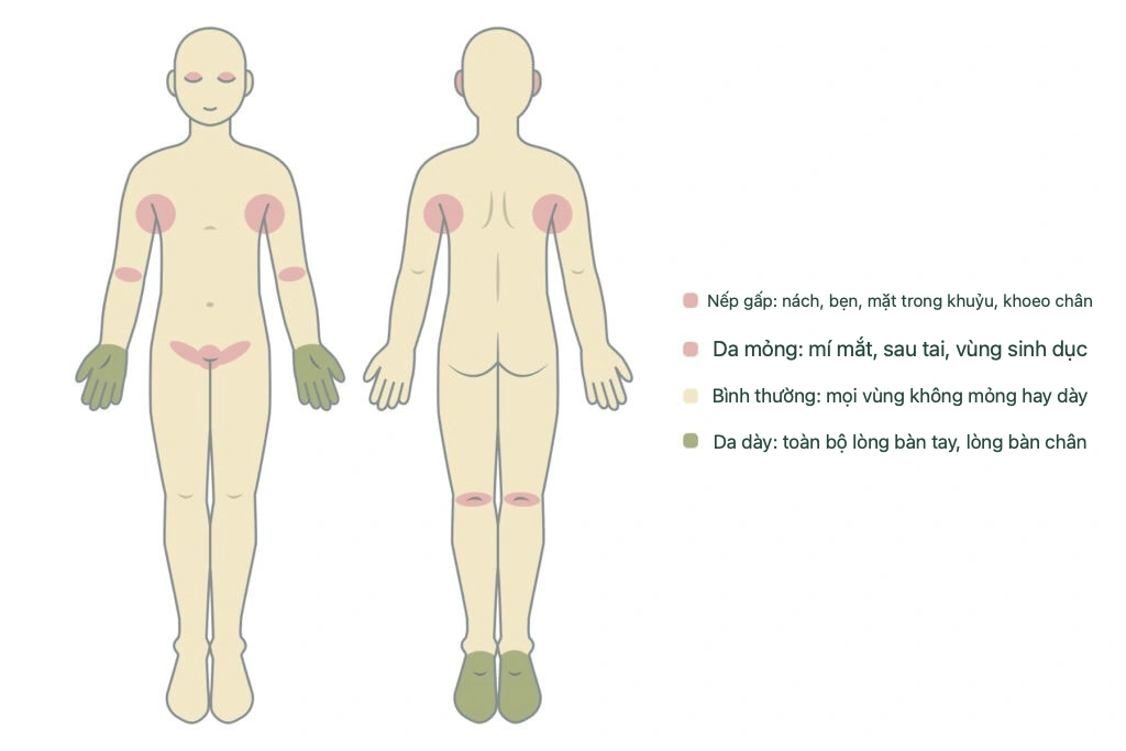 Sơ đồ mức hấp thu steroid khác nhau theo vị trí: mí mắt và vùng sinh dục hấp thu cao, lòng bàn tay và lòng bàn chân hấp thu thấp