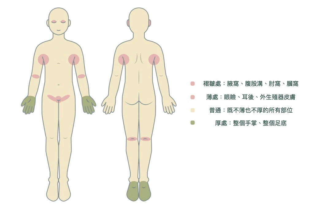 說明不同身體部位吸收外用類固醇差異的資訊圖：眼瞼、生殖器吸收率較高，手掌和腳底較低，應依塗抹部位選擇強度