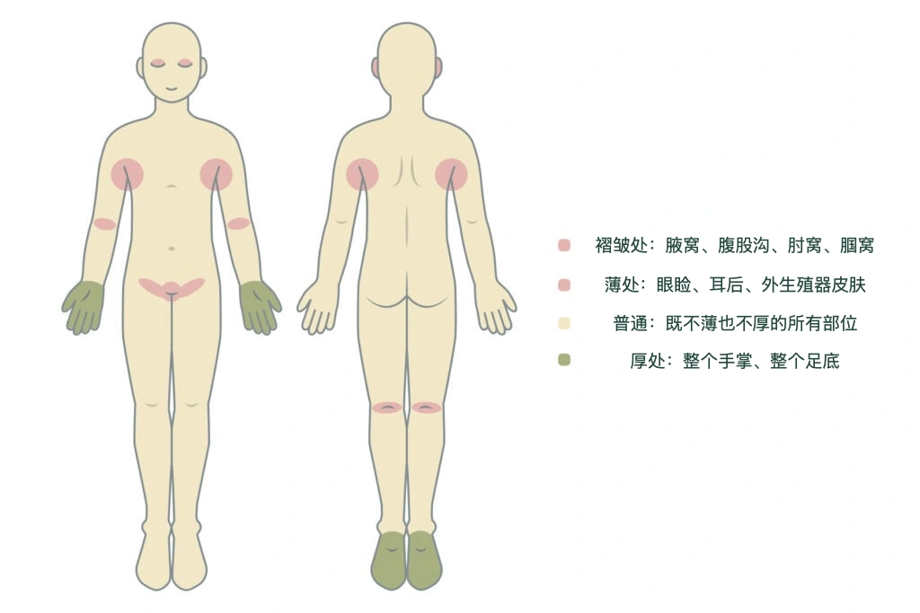 说明不同身体部位吸收外用类固醇差异的信息图：眼睑、生殖器吸收率较高，手掌和脚底较低，应依涂抹部位选择强度