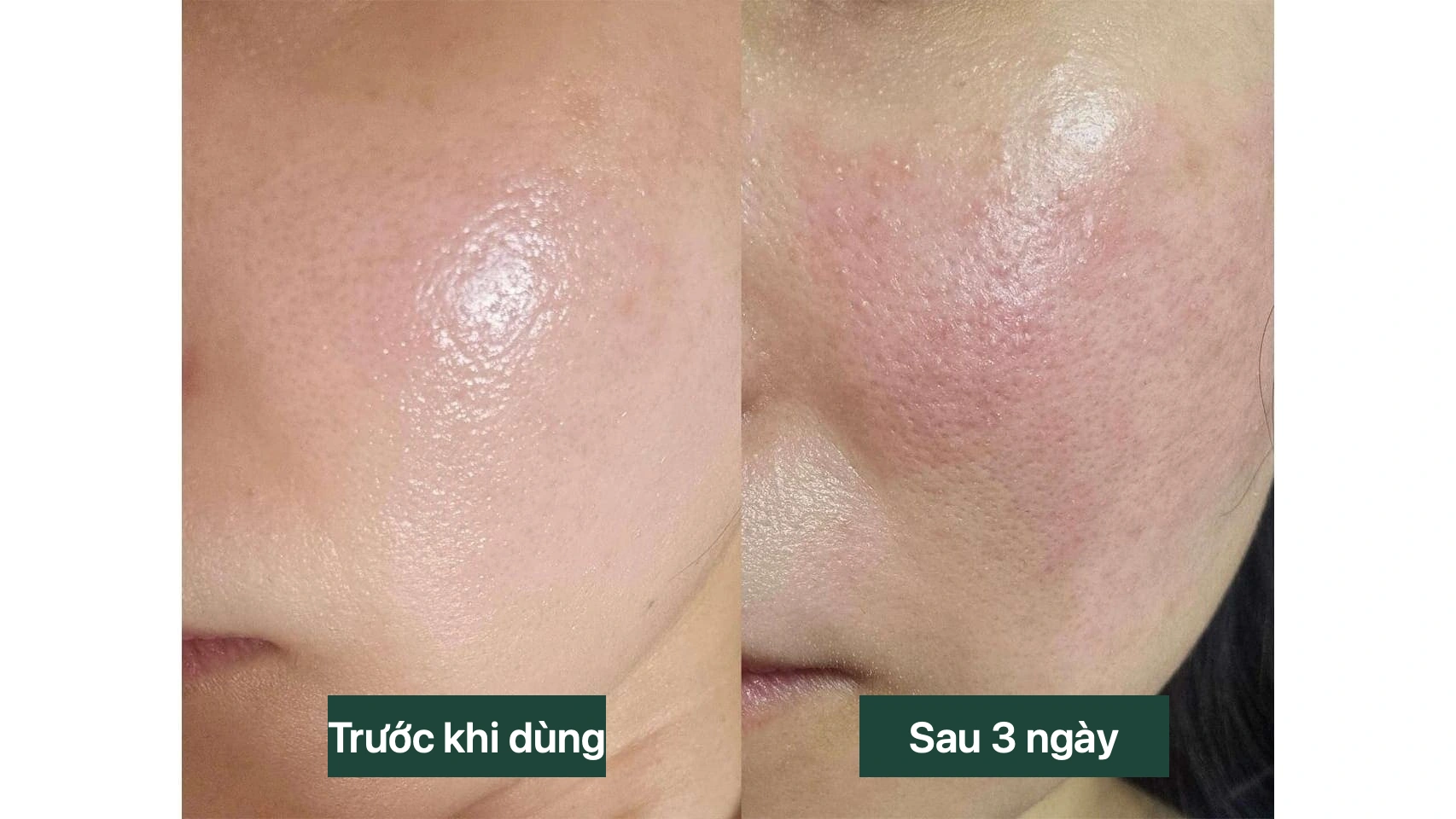 Ảnh lâm sàng so sánh cùng vùng má trước khi bôi kem ivermectin Soolantra và ba ngày sau, cho thấy phản ứng nặng lên ban đầu liên quan đến Demodex chết đi