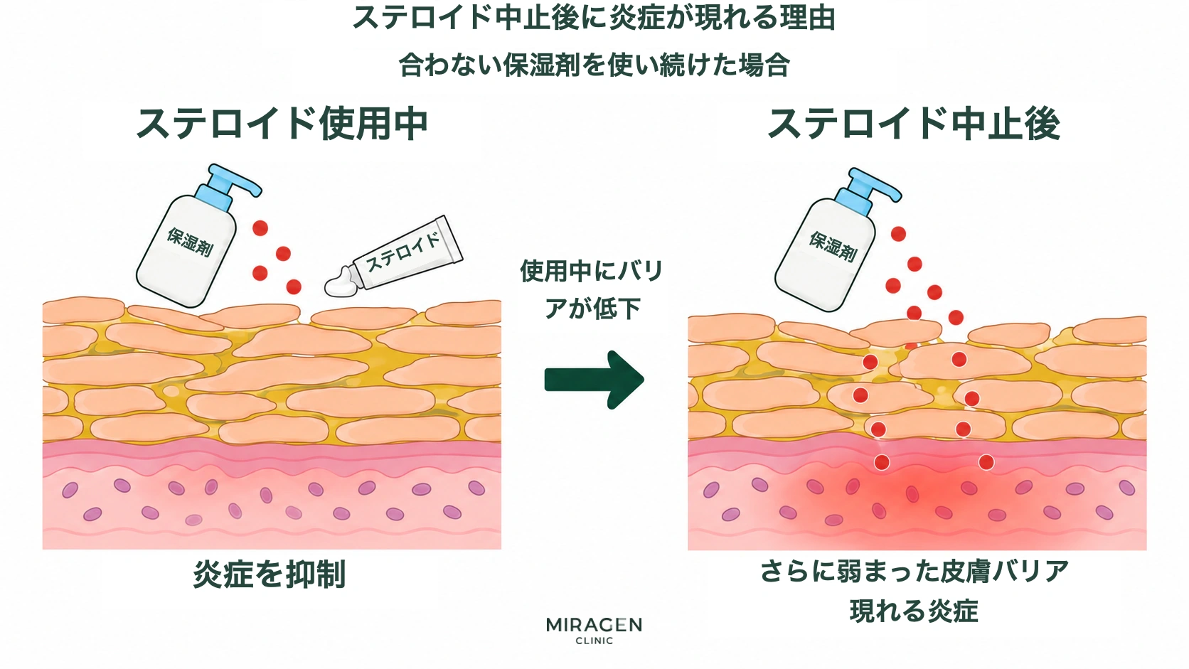 合わない保湿剤を継続使用した場合、ステロイド使用中に抑制された炎症と、バリアがさらに弱くなった状態で中止後に現れる炎症を比較した模式図
