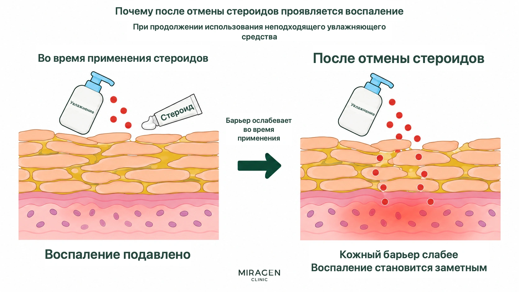 Схема сравнивает скрытое во время применения стероида воспаление от неподходящего увлажняющего средства и проявившееся после отмены мази воспаление на фоне еще более слабого барьера