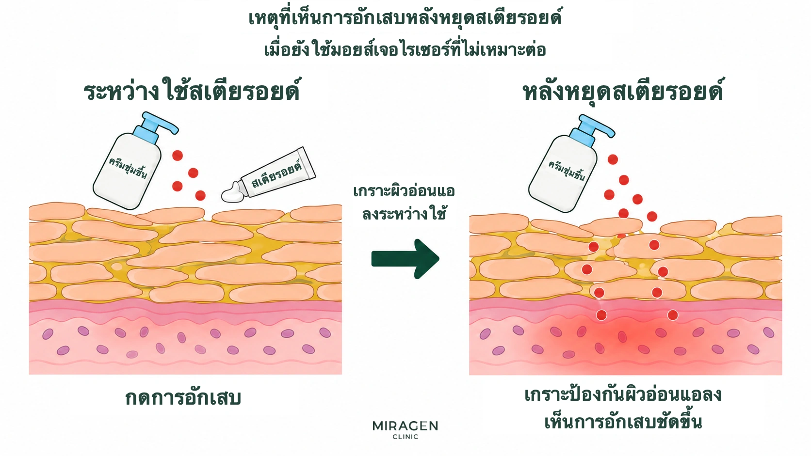 แผนภาพเปรียบเทียบขณะใช้สเตียรอยด์ที่กดการอักเสบจากมอยส์เจอไรเซอร์ไม่เหมาะไว้ กับหลังหยุดยาเมื่อเกราะผิวอ่อนแอและการอักเสบปรากฏ