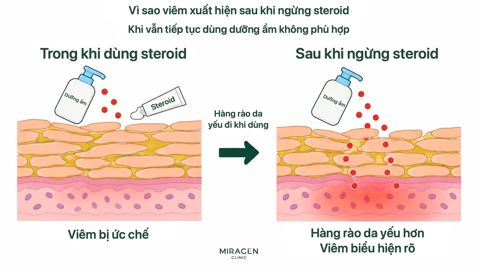 Sơ đồ so sánh tình trạng viêm bị ức chế khi đang dùng steroid với tình trạng viêm bộc lộ sau khi ngừng thuốc trên nền hàng rào da yếu hơn nếu tiếp tục dùng kem dưỡng không phù hợp
