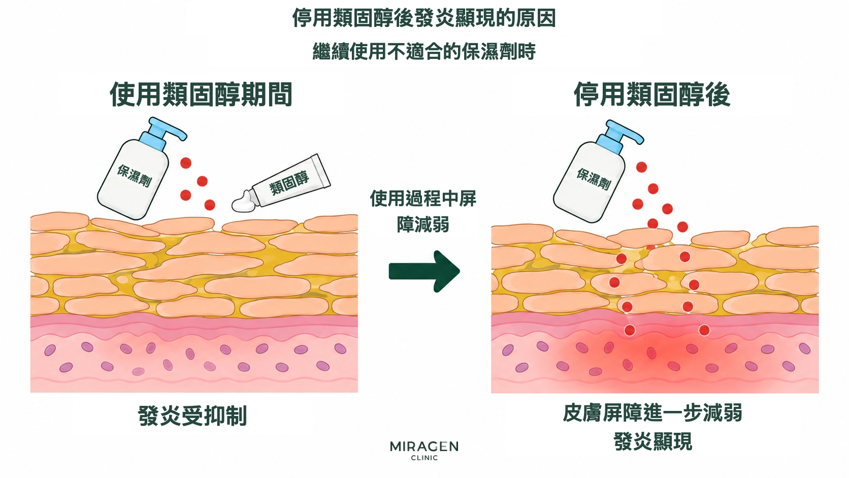 示意圖比較持續使用不適合的保濕劑時,類固醇用藥期間被抑制的發炎,與停藥後在進一步變弱的屏障上顯現的發炎