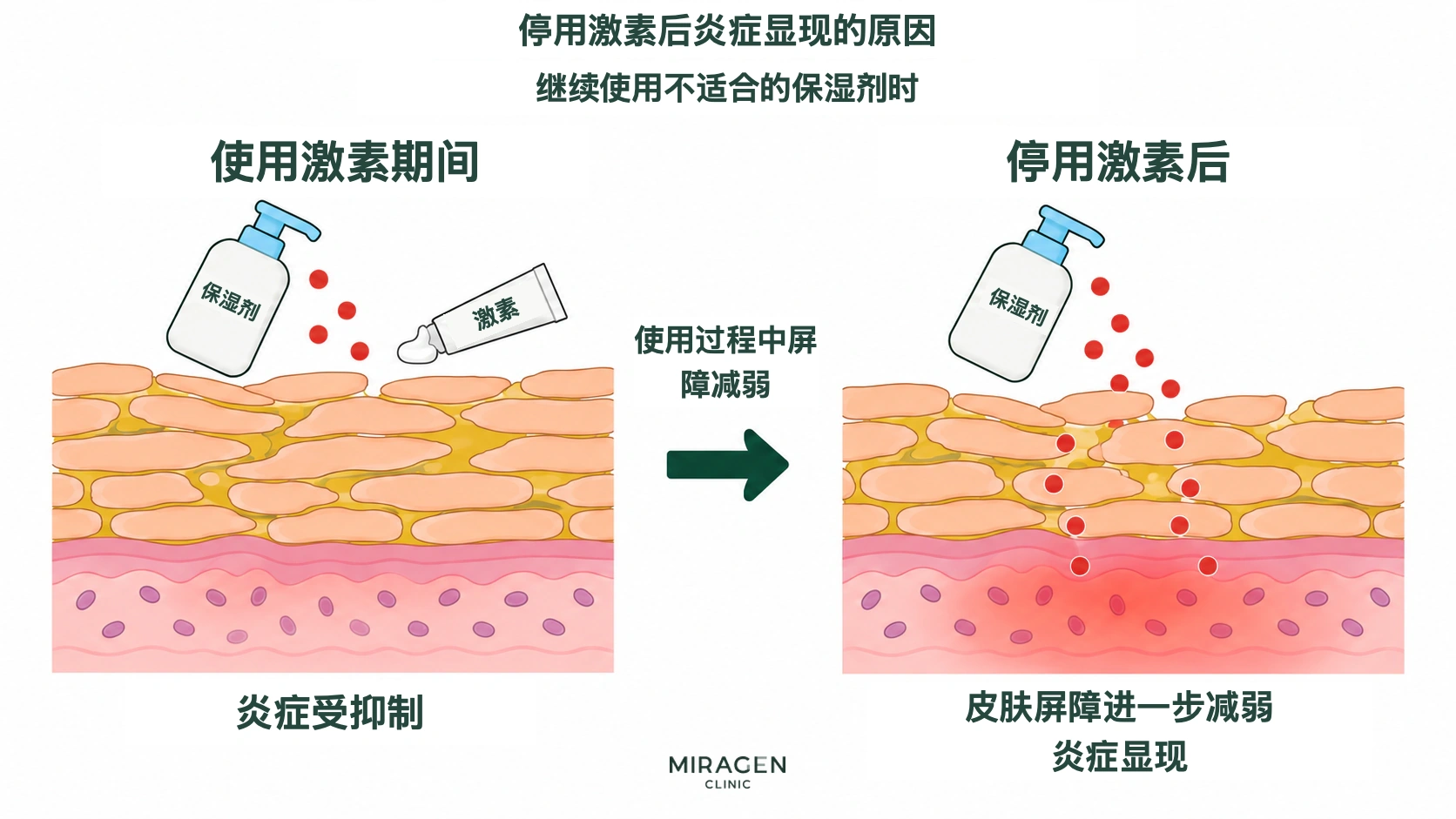 示意图比较持续使用不适合的保湿剂时,类固醇用药期间被抑制的炎症,与停药后在进一步变弱的屏障上显现的炎症