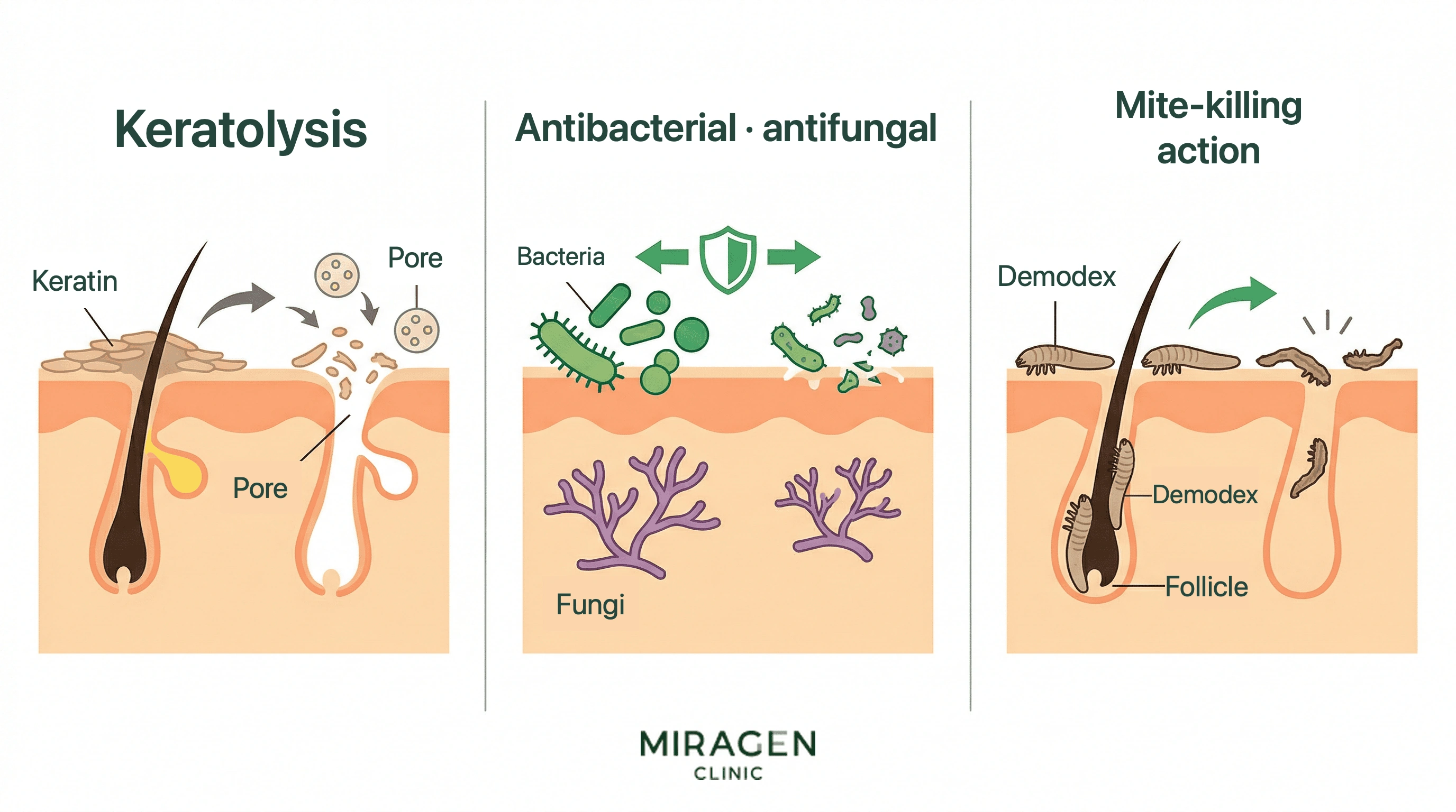 Medical illustration showing the three pharmacological actions of sulfur on the skin — opening pores through keratolysis, inhibiting bacterial and fungal growth, and killing demodex mites.
