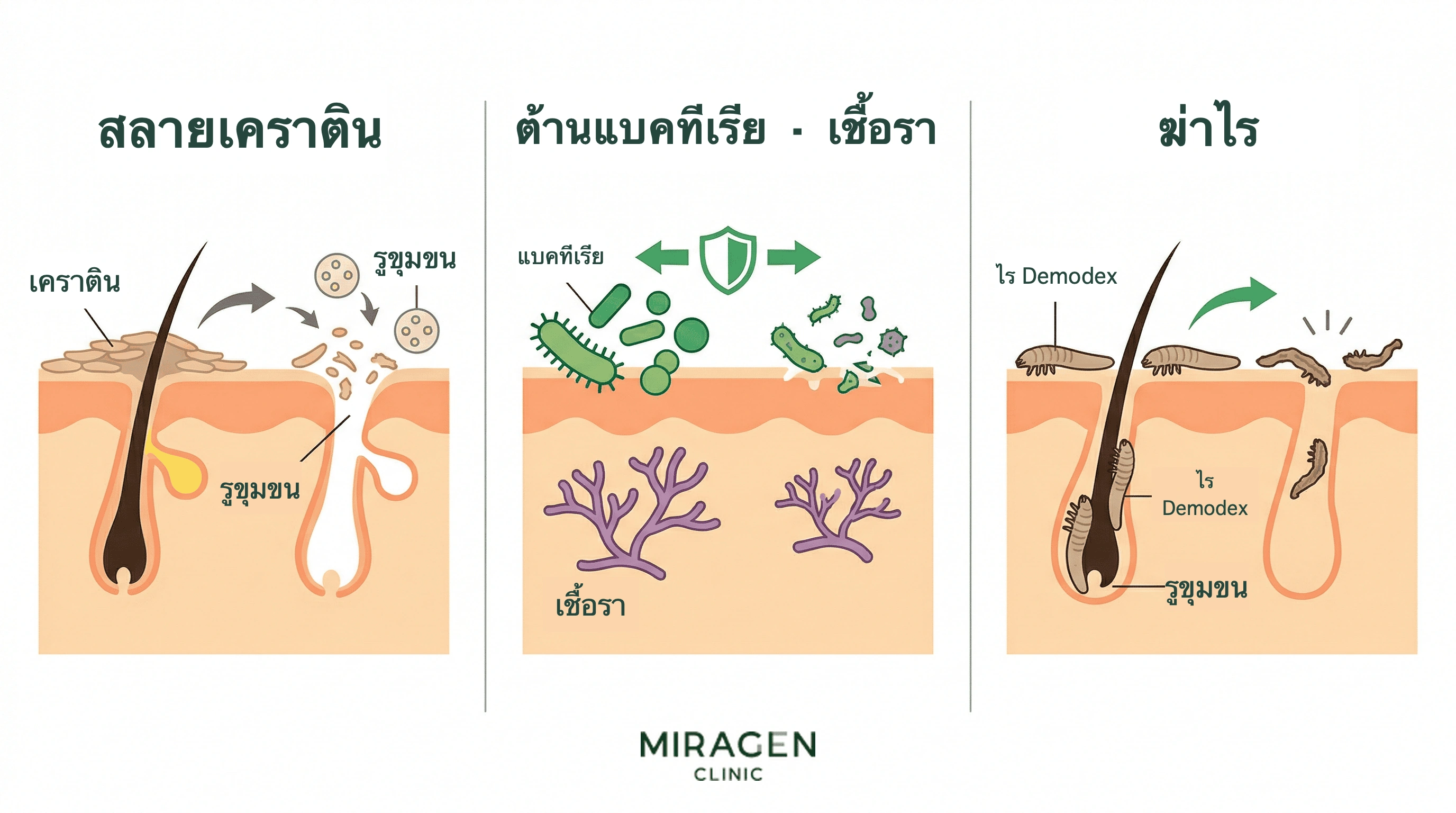 ภาพทางการแพทย์แสดงสามฤทธิ์ของกำมะถัน ได้แก่ ช่วยให้เซลล์ผิวหลุดเพื่อเปิดรูขุมขน ยับยั้งแบคทีเรียและเชื้อรา และกำจัดไรเดโมเด็กซ์