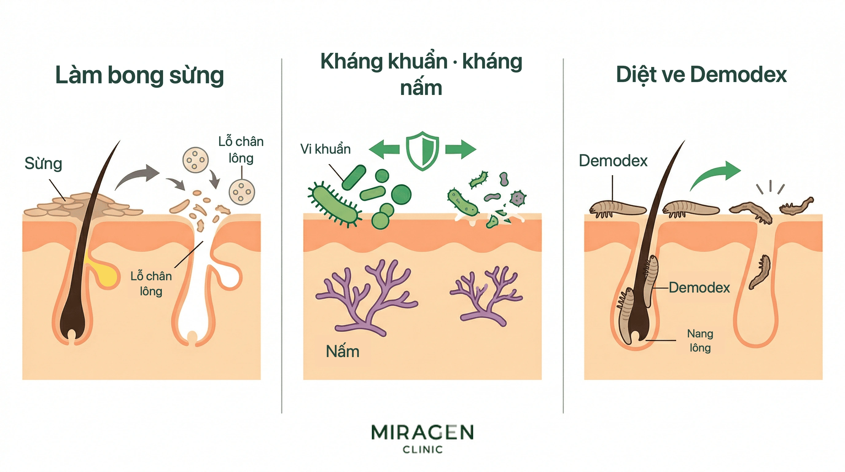 Minh họa y khoa ba tác động của lưu huỳnh trên da: làm bong lớp sừng và thông lỗ chân lông, ức chế vi khuẩn và nấm, diệt Demodex