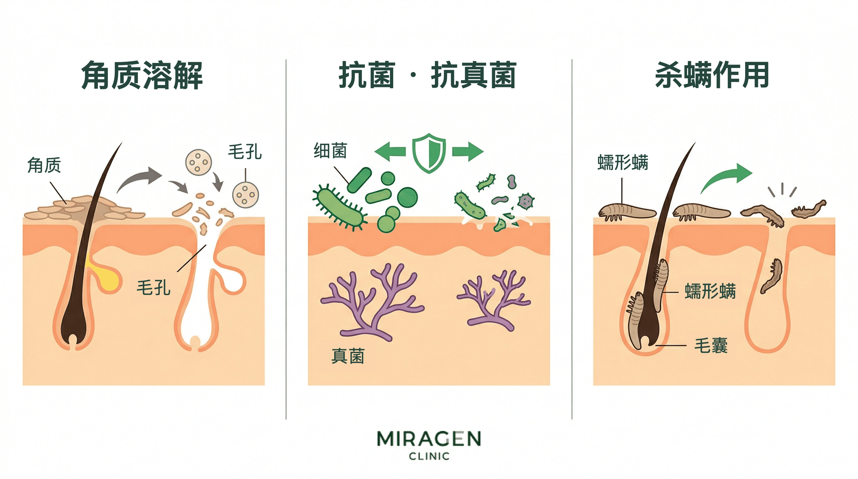 医学插图展示硫磺对皮肤的三种药理作用：溶解角质以疏通毛孔、抑制细菌和真菌生长、抑制蠕形螨