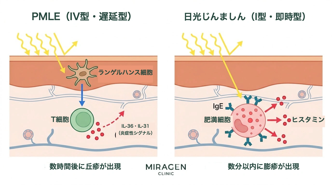 PMLEのT細胞機序(IV型遅延型)と日光蕁麻疹の肥満細胞・IgE機序(I型即時型)を皮膚断面で比較した免疫経路イラスト。