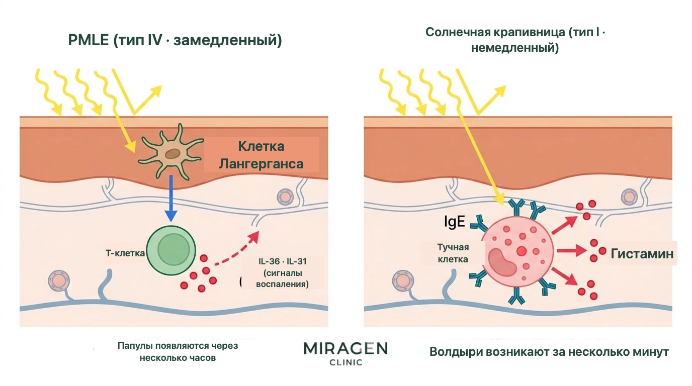 Иллюстрация поперечного среза кожи сравнивает Т-клеточный механизм PMLE (замедленная реакция IV типа) с механизмом солнечной крапивницы, связанным с тучными клетками и IgE (немедленная реакция I типа)