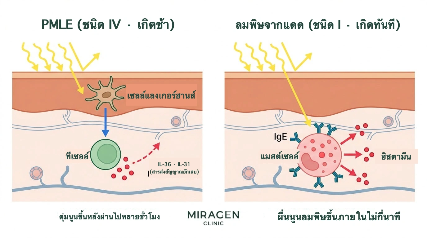 ภาพเปรียบเทียบเส้นทางภูมิคุ้มกันของ PMLE ที่อาศัยทีเซลล์แบบล่าช้าชนิด IV กับลมพิษจากแสงแดดที่อาศัยเซลล์มาสต์และ IgE แบบทันทีชนิด I