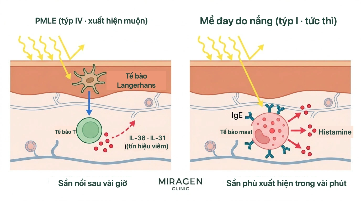 Minh họa trên mặt cắt da so sánh cơ chế tế bào T quá mẫn muộn type IV của PMLE với cơ chế tế bào mast và IgE quá mẫn tức thì type I của mề đay do ánh nắng