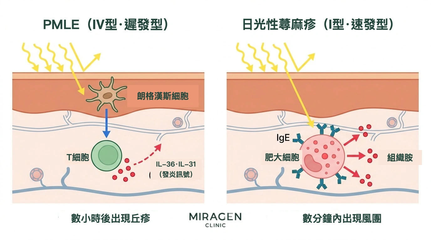 免疫通路插圖：在皮膚剖面中比較 PMLE 的 T 細胞機制（IV 型遲發反應）與日光性蕁麻疹的肥大細胞和 IgE 機制（I 型速發反應）