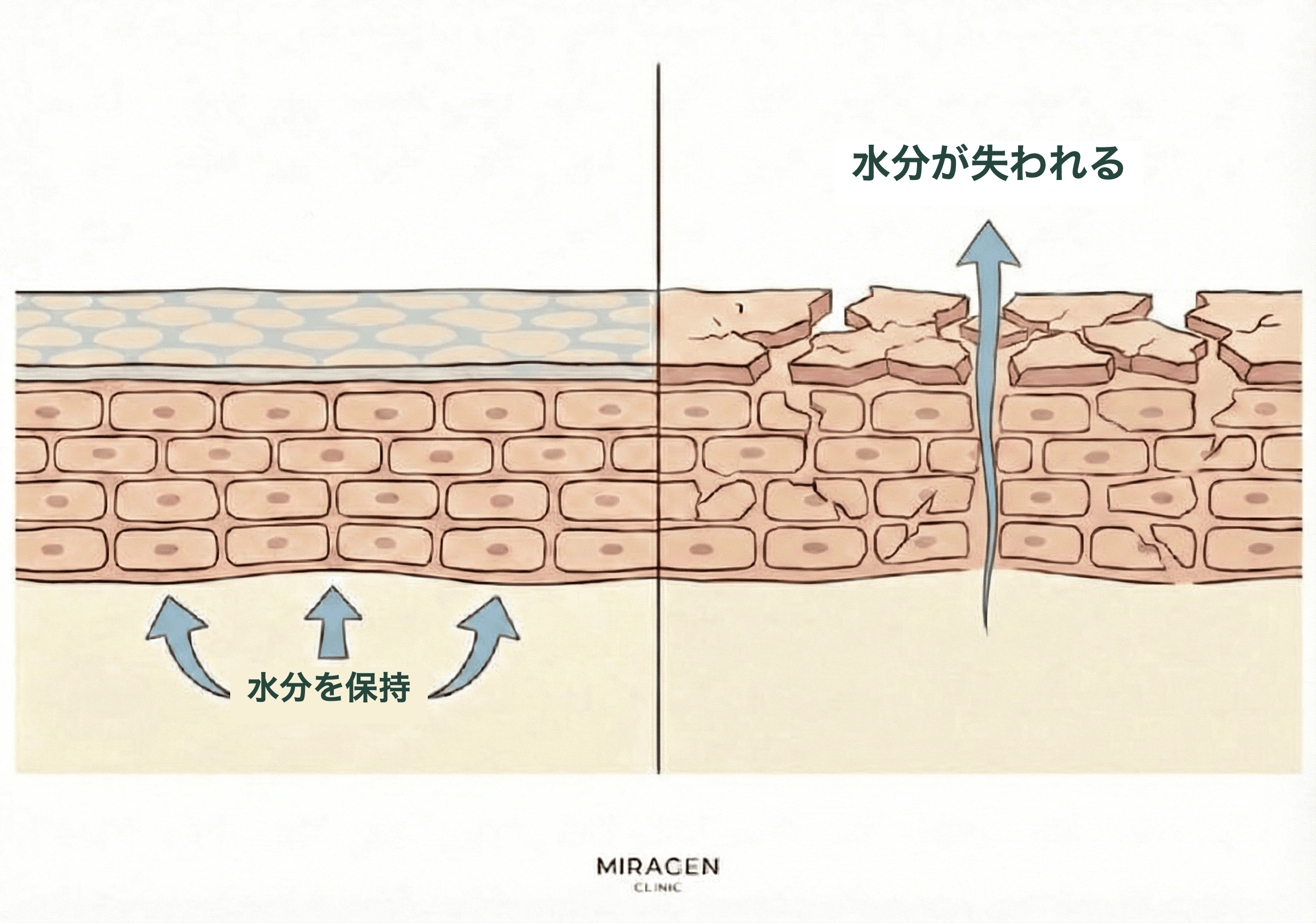硫黄石鹸の高いpH(9〜10)が肌バリアを損傷させ、水分が逃げて乾燥していく過程を正常な肌バリアと比較したイラスト