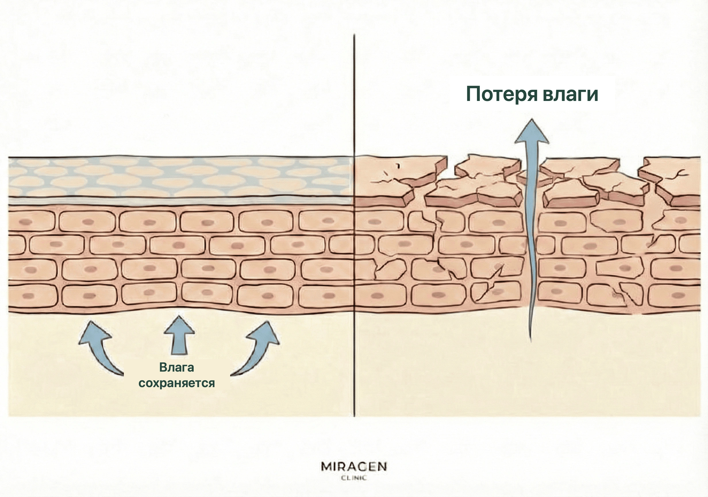 Иллюстрация сравнивает нормальный кожный барьер с повреждением от серного мыла pH 9–10 и усиленной потерей влаги