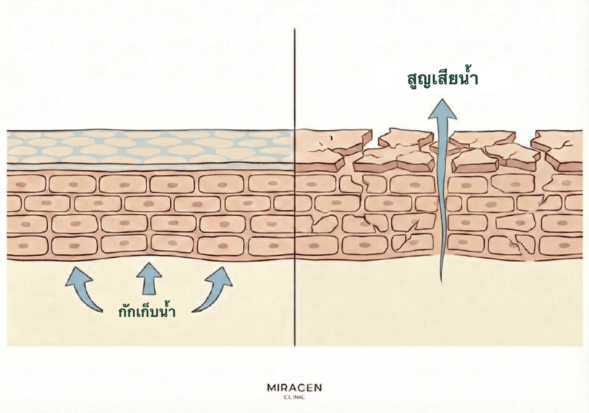 ภาพเปรียบเทียบเกราะผิวปกติกับผิวที่ได้รับผลจากสบู่กำมะถัน pH 9–10 จนเกราะเสีย น้ำสูญเสียมากขึ้นและผิวแห้ง