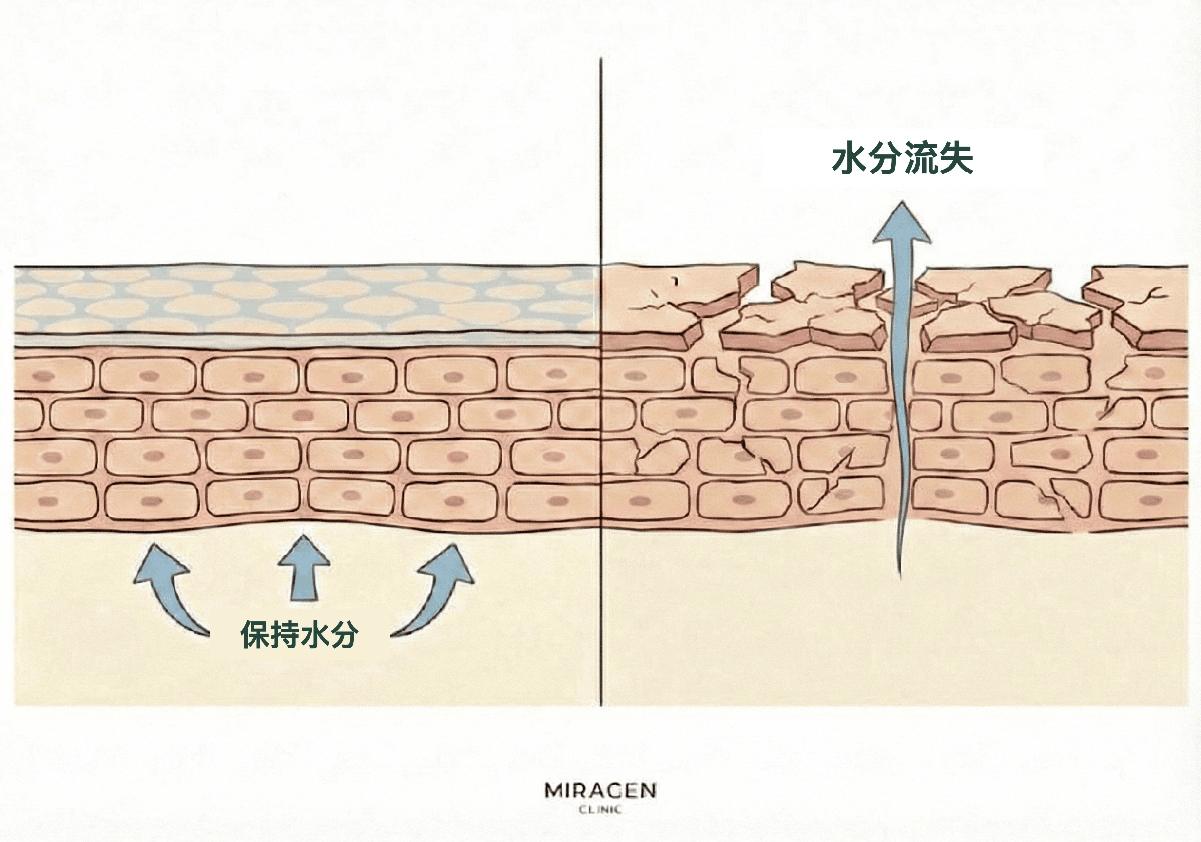 插图比较正常皮肤屏障与受硫磺皂高 pH 值（9~10）损伤的皮肤屏障，展示水分流失和皮肤干燥的过程