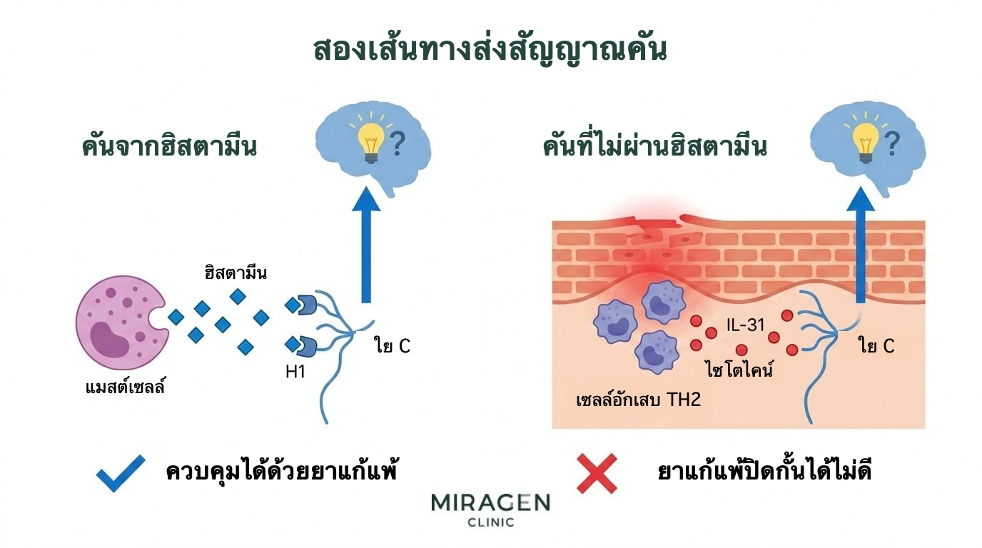 ภาพเปรียบเทียบเส้นทางอาการคันจากฮิสตามีนที่เซลล์มาสต์ปล่อยสารกระตุ้นเส้นประสาท C และยาต้านฮิสตามีนช่วยได้ กับเส้นทางที่สารอักเสบอย่าง IL-31 กระตุ้นเส้นประสาทโดยตรงและยาต้านฮิสตามีนช่วยได้น้อย