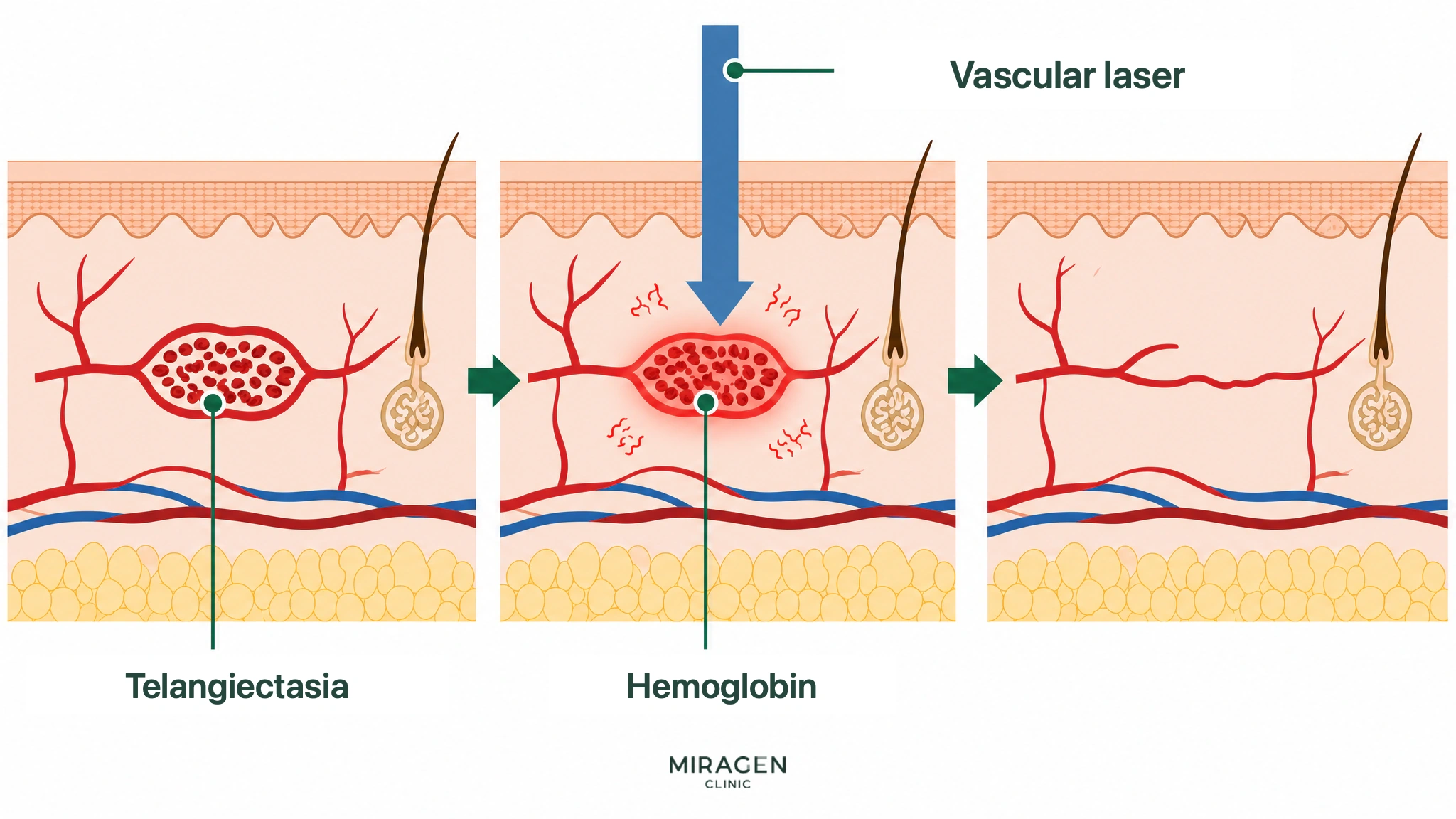 Medical cross-sectional skin illustration showing how a flushing laser (vascular laser) is absorbed by hemoglobin in telangiectasia, converts to heat, and reduces blood vessels