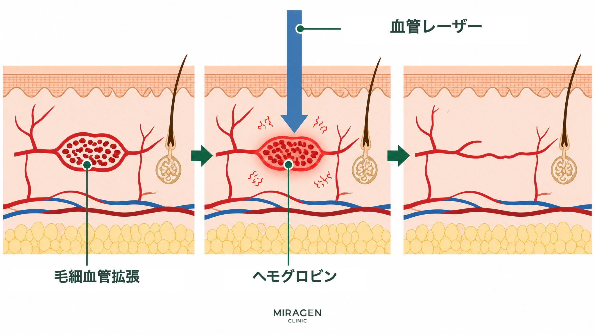 赤ら顔レーザー(血管レーザー)が毛細血管拡張症内のヘモグロビンに吸収されて熱に変わり、血管を減らす過程を示した皮膚断面の医療イラスト