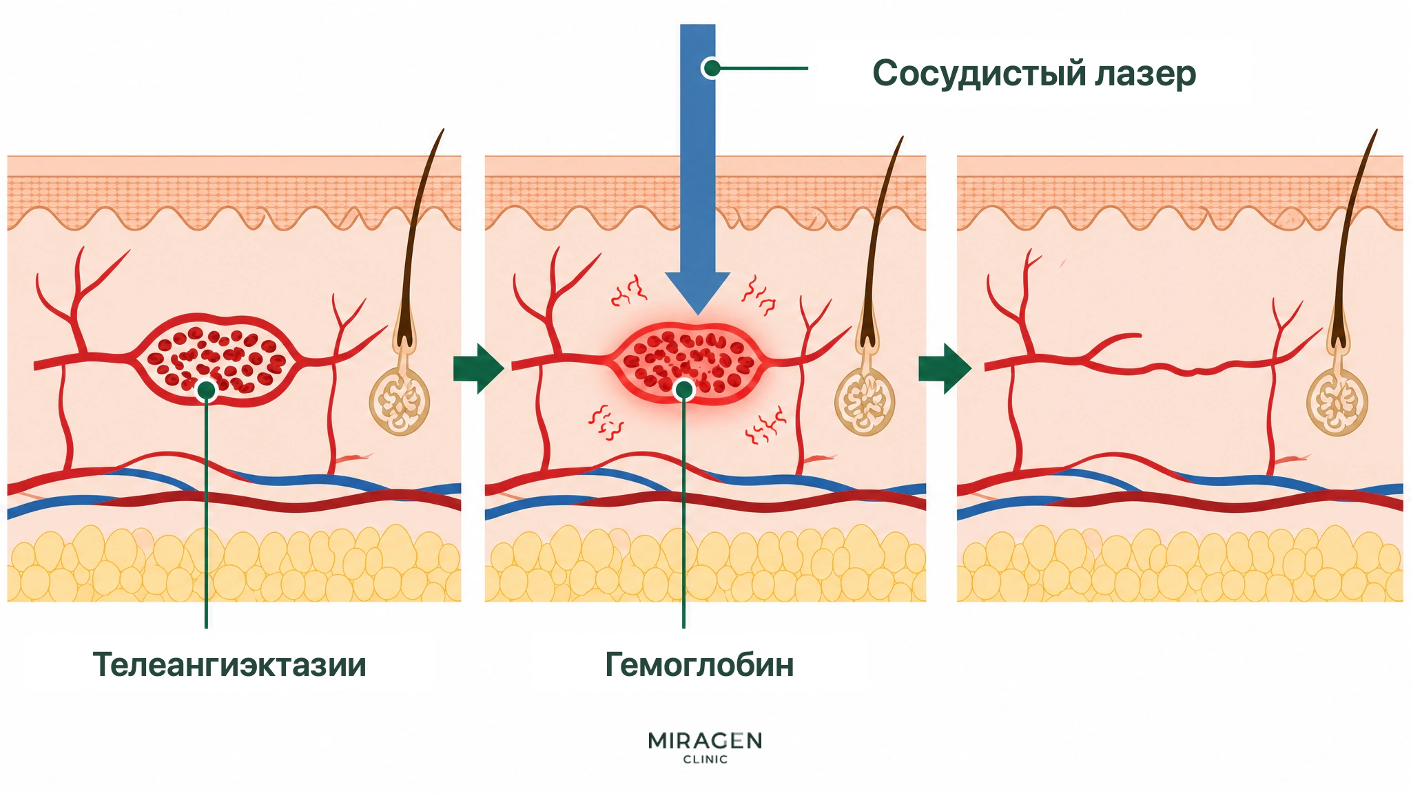Медицинская иллюстрация поперечного среза кожи показывает, как свет сосудистого лазера поглощается гемоглобином в расширенных капиллярах, превращается в тепло и уменьшает сосуды