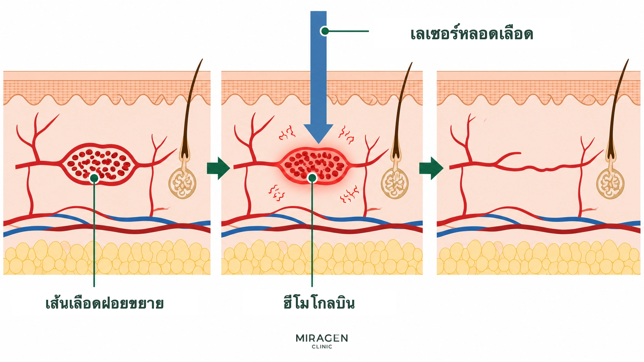ภาพตัดขวางผิวหนังแสดงแสงจากเลเซอร์หลอดเลือดถูกฮีโมโกลบินในหลอดเลือดฝอยที่ขยายตัวดูดซับ เปลี่ยนเป็นความร้อน และลดขนาดหลอดเลือด