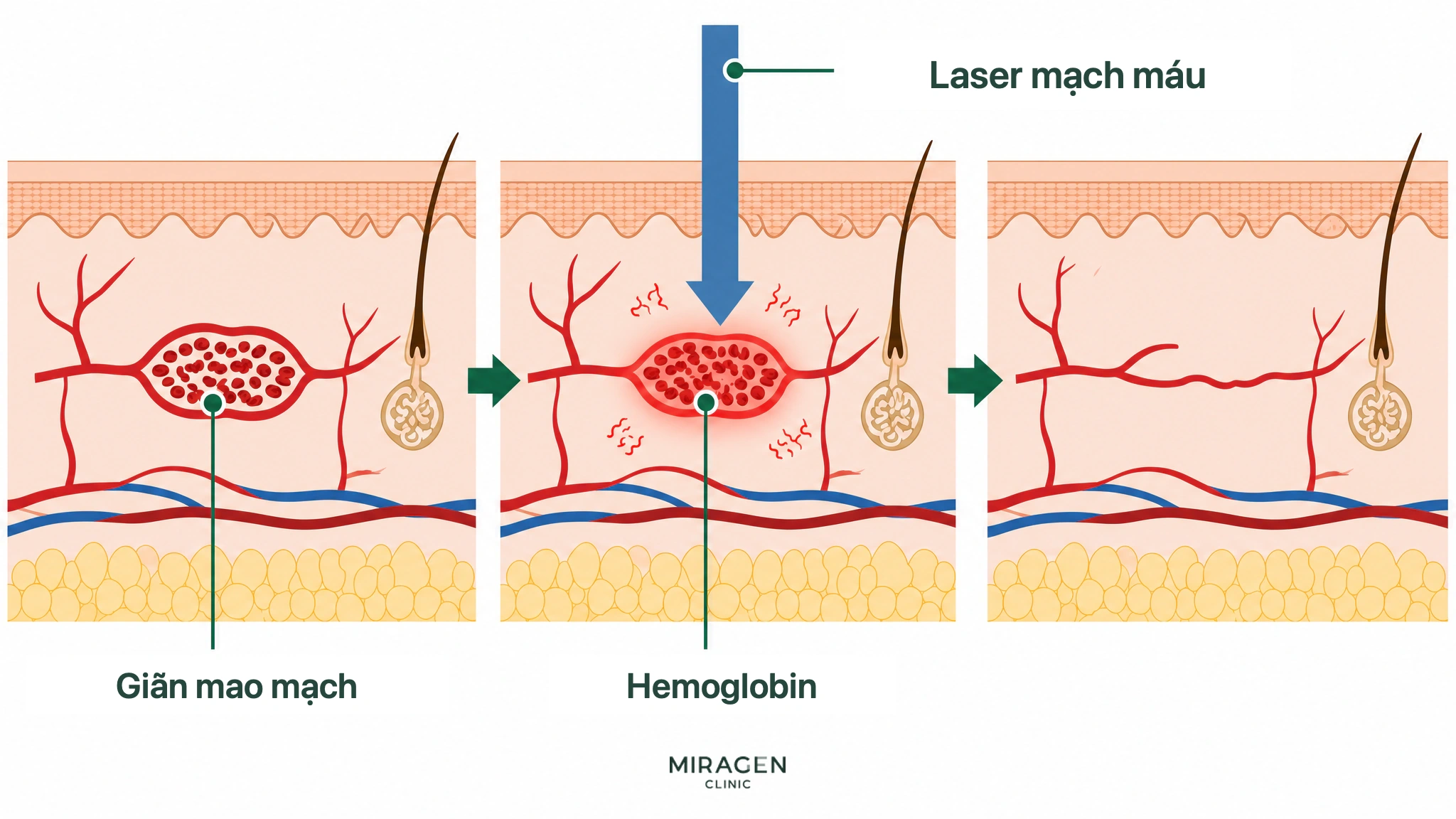 Minh họa mặt cắt da cho thấy laser mạch máu được hemoglobin trong mạch giãn hấp thu, chuyển thành nhiệt và làm mạch nhỏ lại