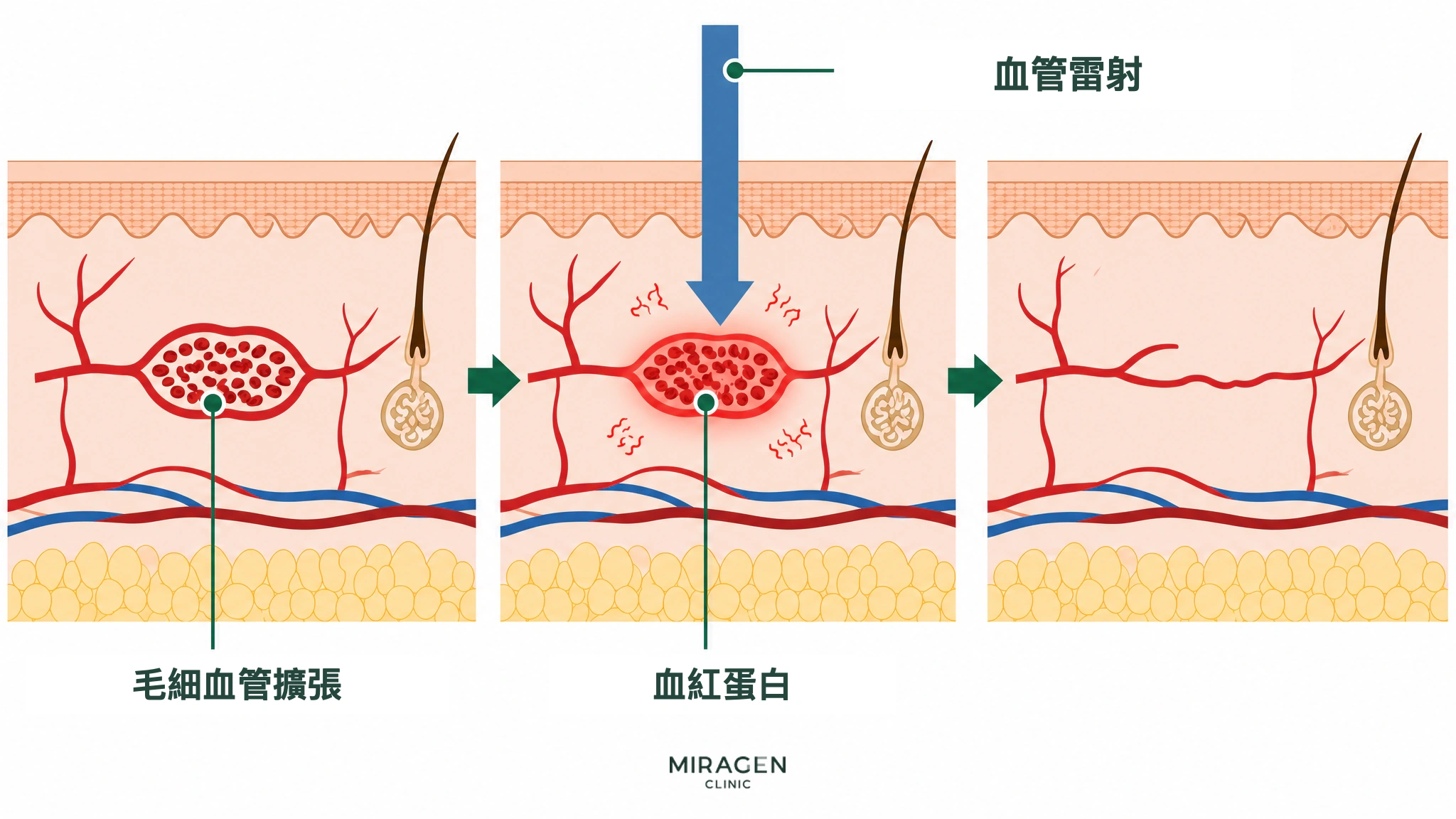 皮膚剖面醫學插圖：血管雷射被擴張毛細血管中的血紅蛋白吸收，轉化為熱並使血管減少