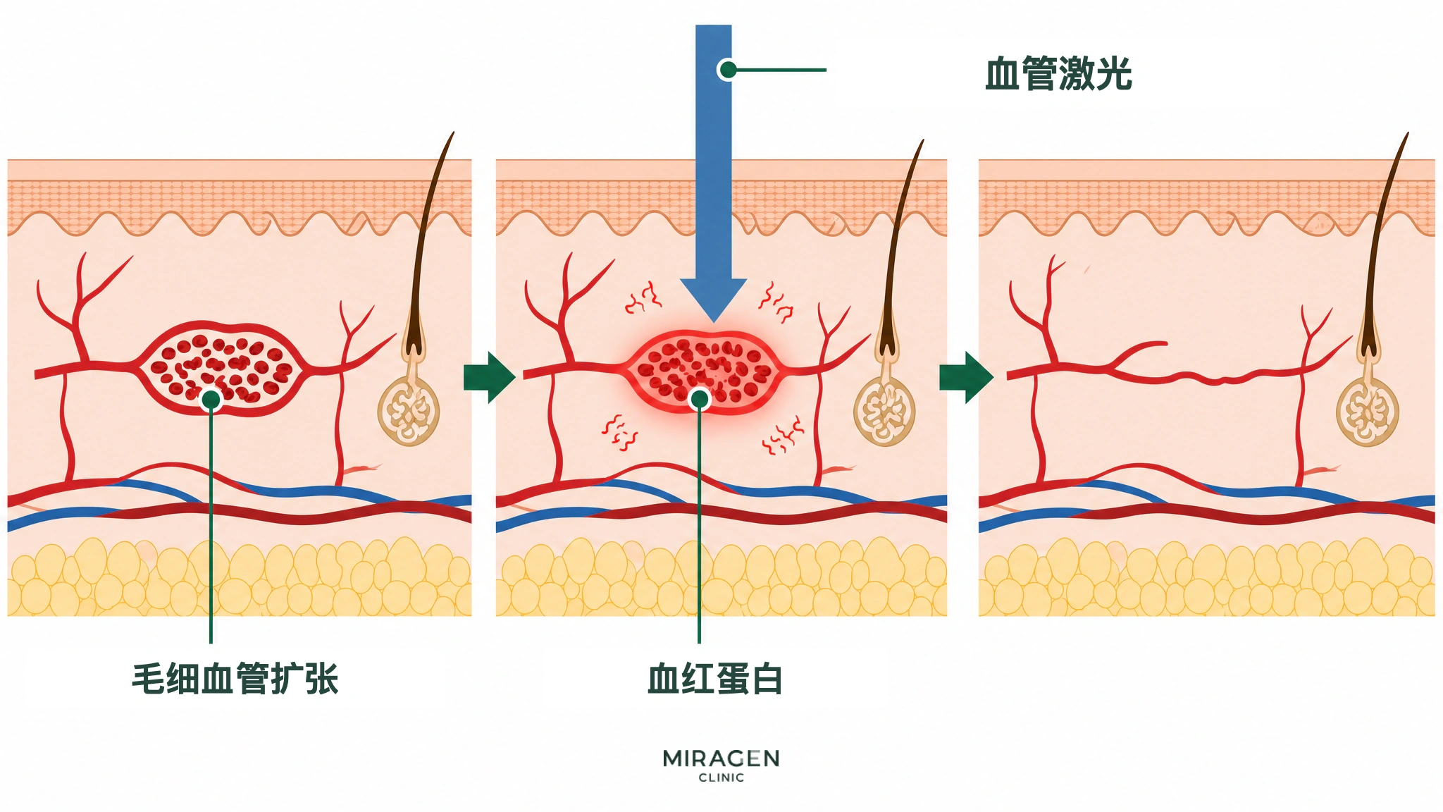 皮肤剖面医学插图：血管激光被扩张毛细血管中的血红蛋白吸收，转化为热并使血管减少