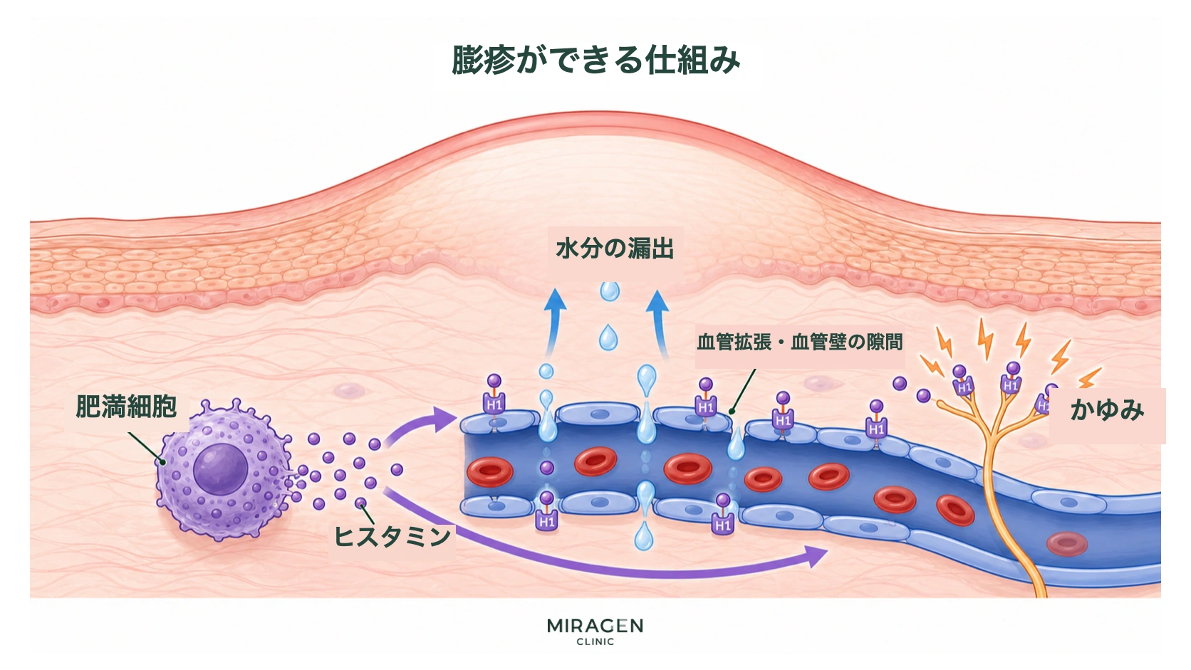 肥満細胞から放出されたヒスタミンが血管と感覚神経のH1受容体に結合し、血管壁の隙間から水分が漏れ出して膨疹とかゆみが生じるメカニズムを示す図