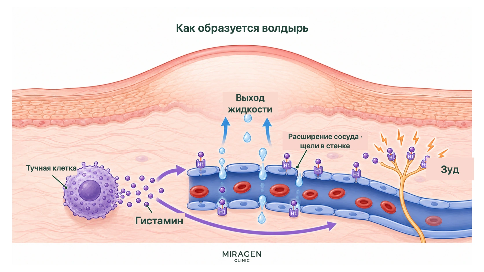 Схема показывает, как гистамин тучных клеток связывается с H1-рецепторами сосудов и нервов, жидкость выходит через сосудистую стенку и возникают волдыри и зуд