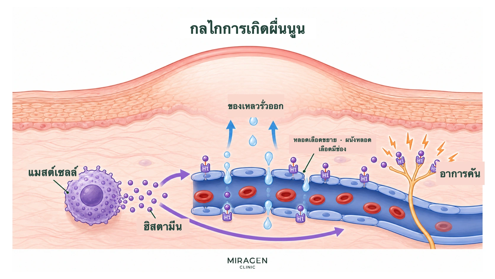 ภาพกลไกฮิสตามีนจากมาสต์เซลล์จับตัวรับ H1 ที่หลอดเลือดและเส้นประสาทรับความรู้สึก ทำให้น้ำออกผ่านช่องในผนังหลอดเลือด เกิดผื่นนูนและคัน